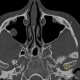 Cyst of maxillary sinus: CT - Computed tomography